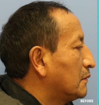 Rhinoplasty before and after - before