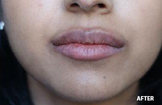 Lip Augmentation - Filler before and after - after