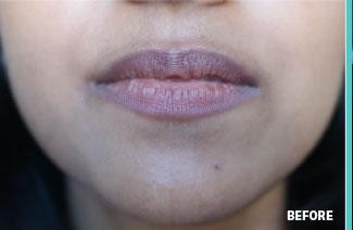 Lip Augmentation - Filler before and after - before