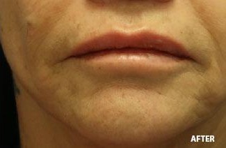 Lip Augmentation - Filler before and after - after