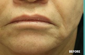 Lip Augmentation - Filler before and after - before