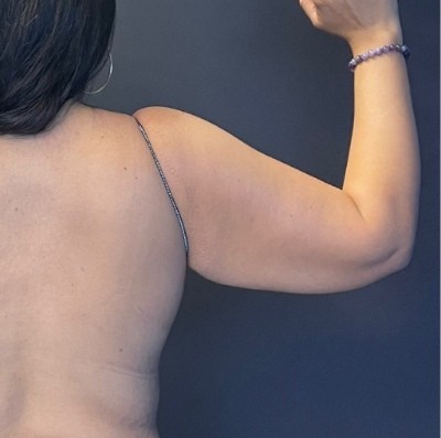 Brachioplasty before and after - after