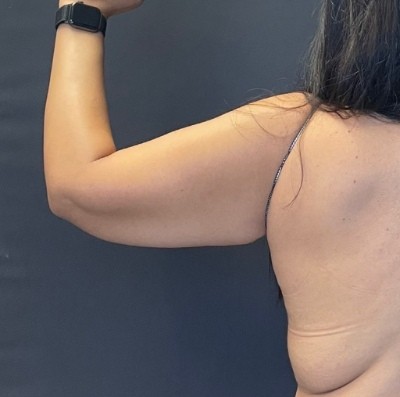 Brachioplasty before and after - before