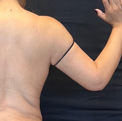 Brachioplasty before and after - after