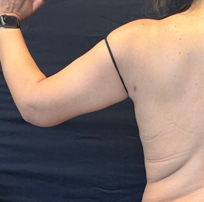 Brachioplasty before and after - before