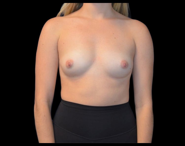 Breast Augmentation before and after - before