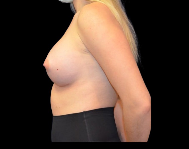 Breast Augmentation before and after - after
