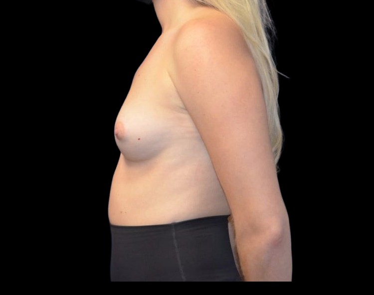 Breast Augmentation before and after - before