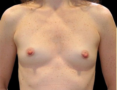 Breast Augmentation before and after - before
