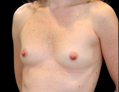 Breast Augmentation before and after - before