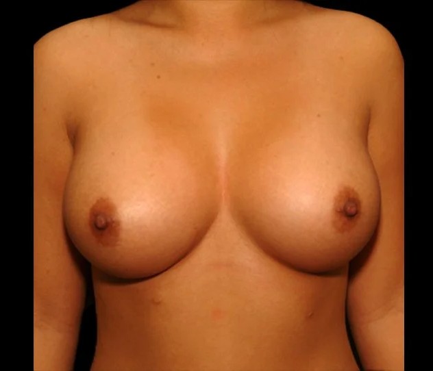 Breast Augmentation before and after - after