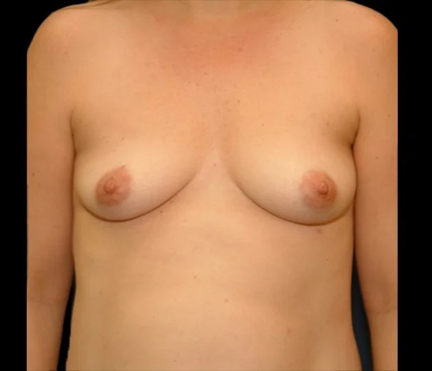 Breast Augmentation before and after - before