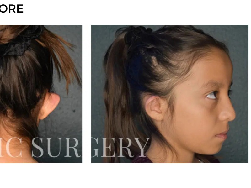 Procedure before and after - after