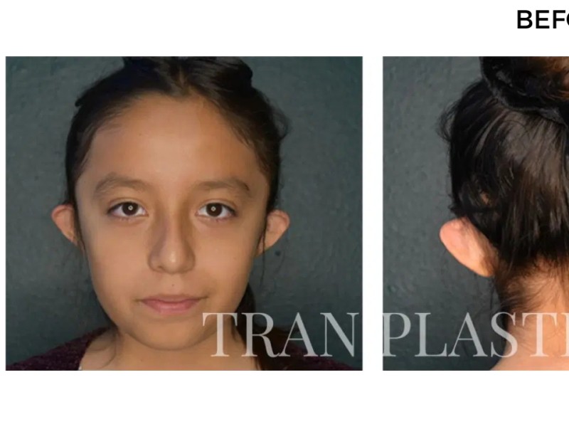 Procedure before and after - before