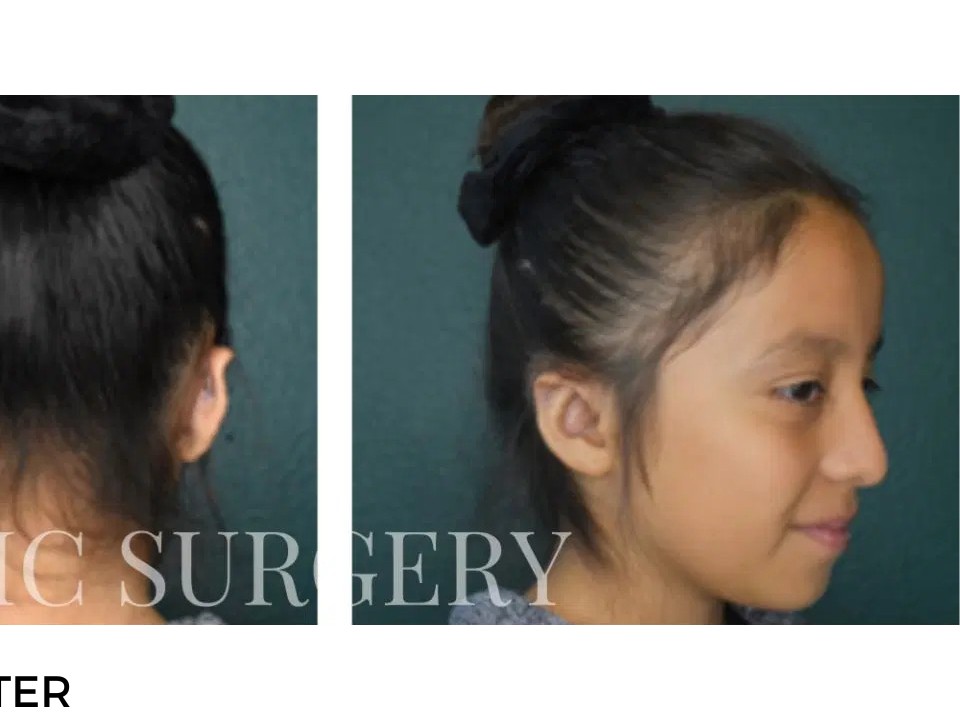 Procedure before and after - after