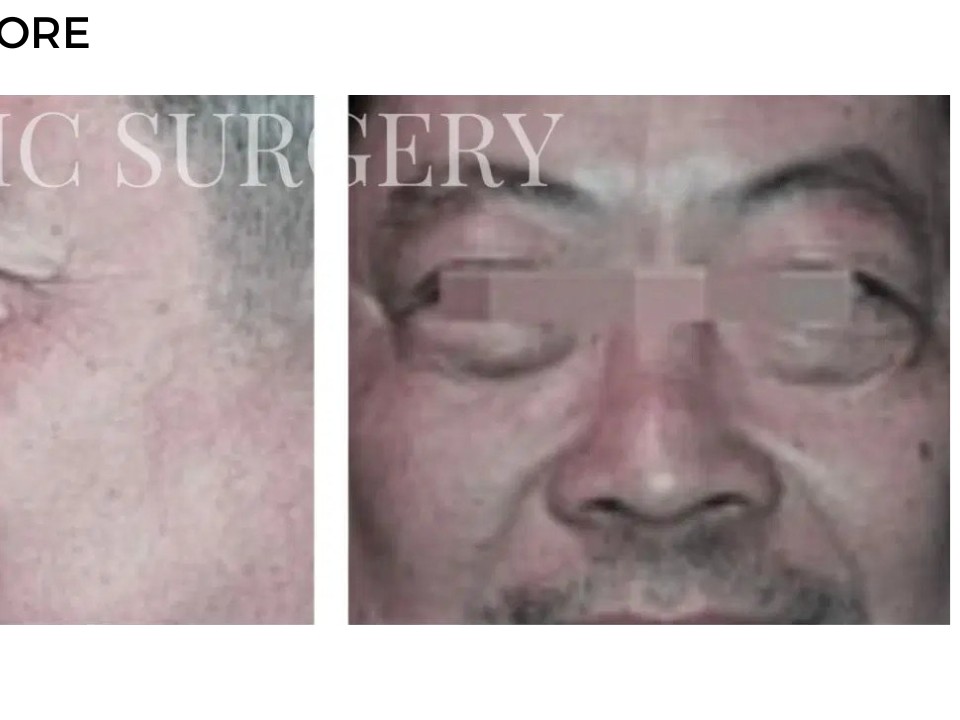 Procedure before and after - after