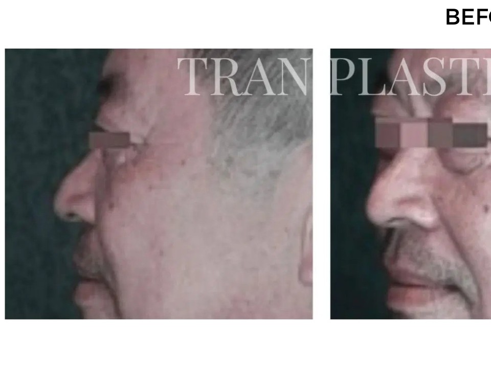 Procedure before and after - before