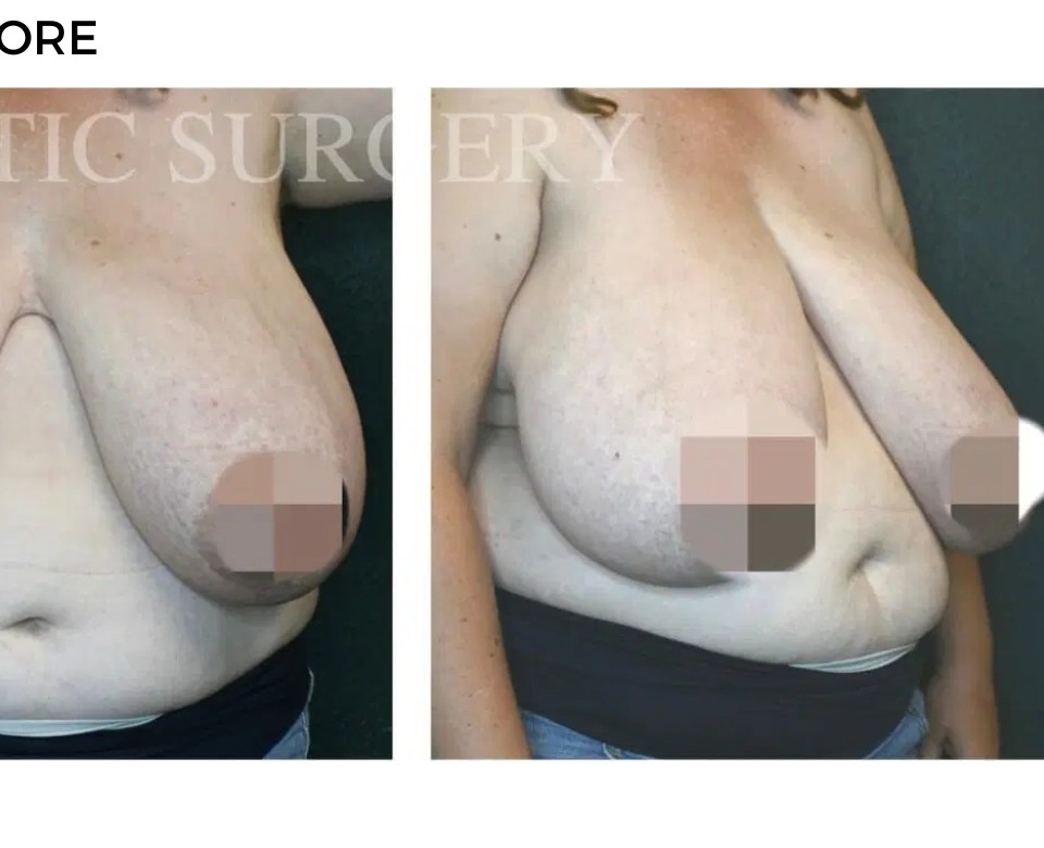 Procedure before and after - after