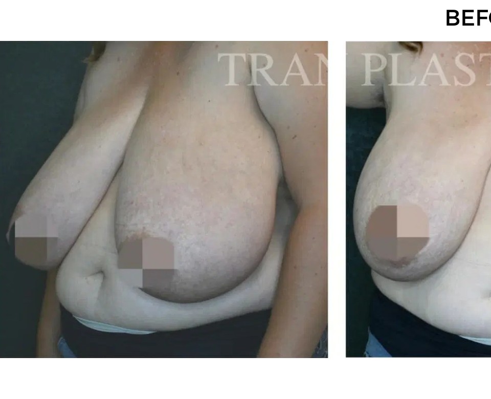 Procedure before and after - before