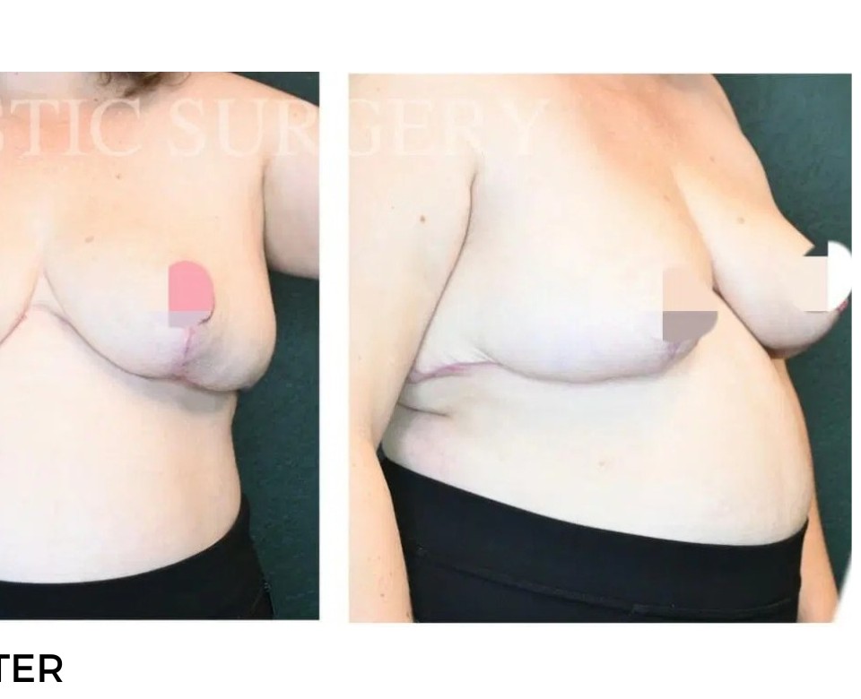 Procedure before and after - after