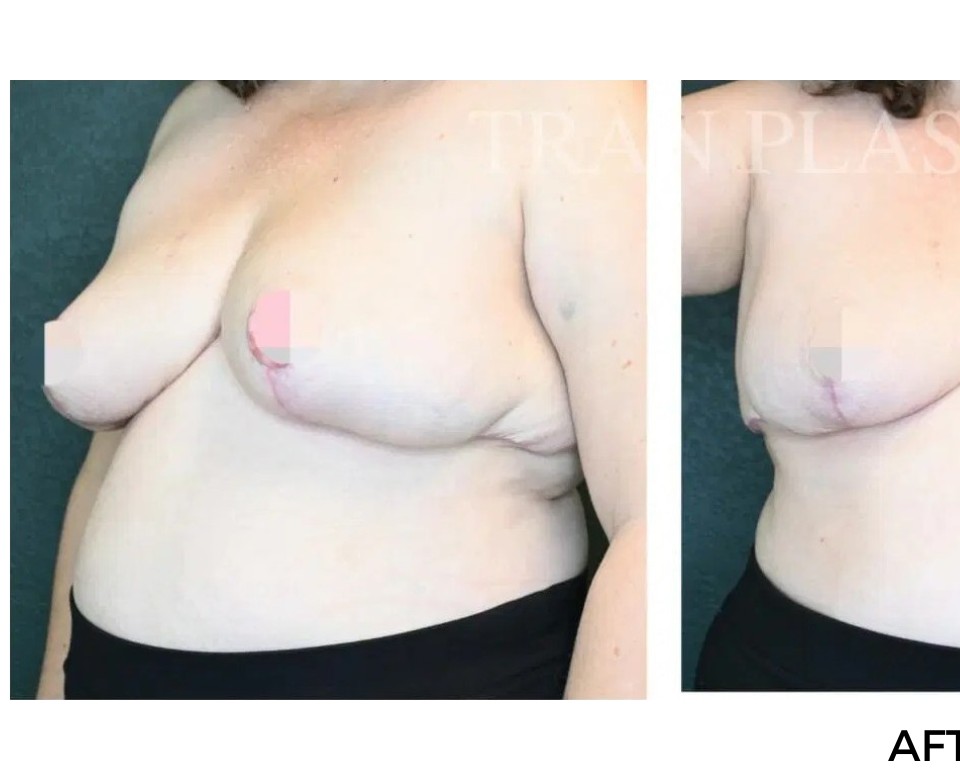 Procedure before and after - before