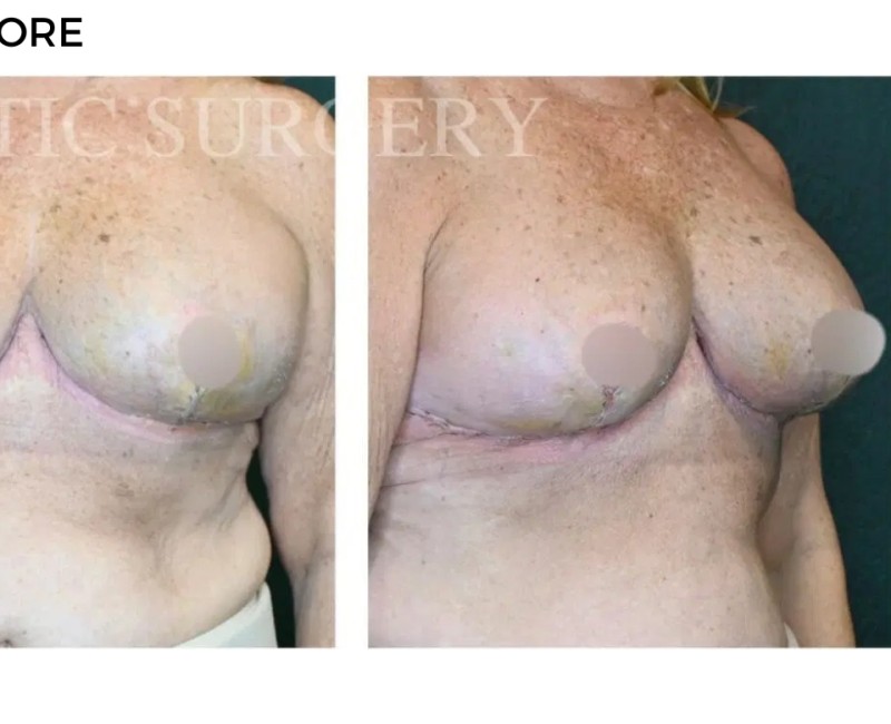 Procedure before and after - after
