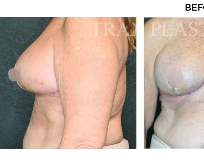 Procedure before and after - before