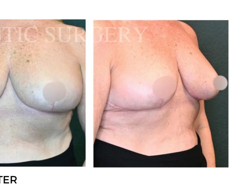 Procedure before and after - after