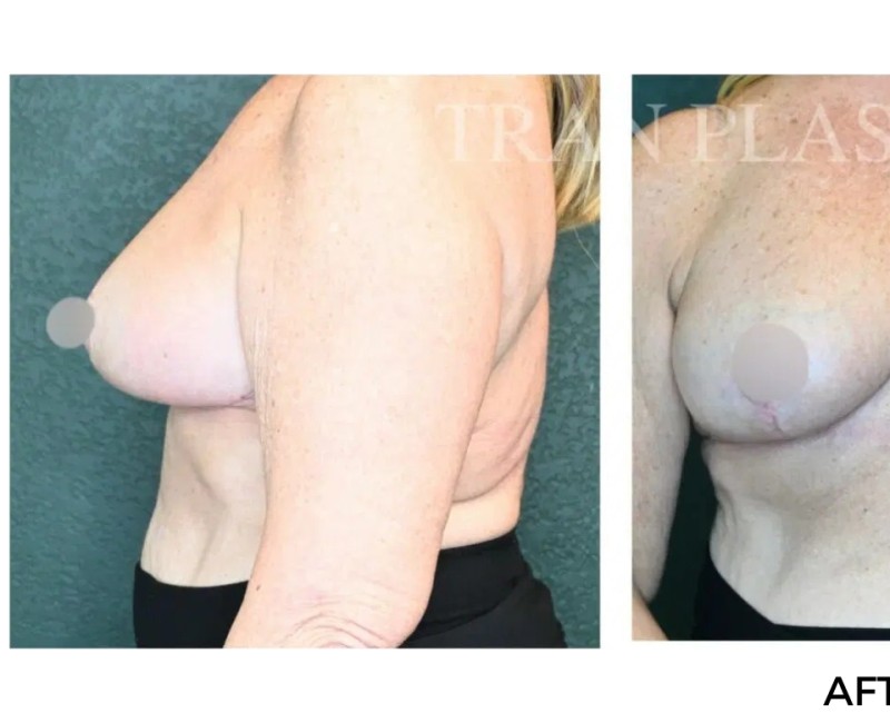 Procedure before and after - before