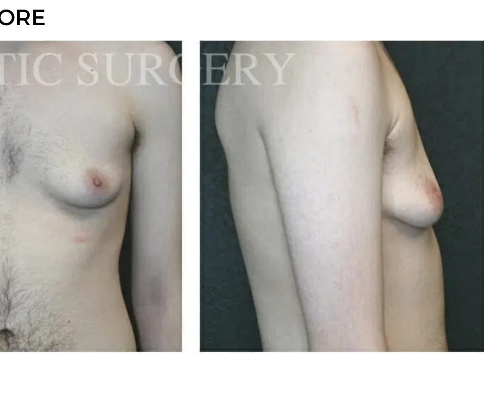Procedure before and after - after