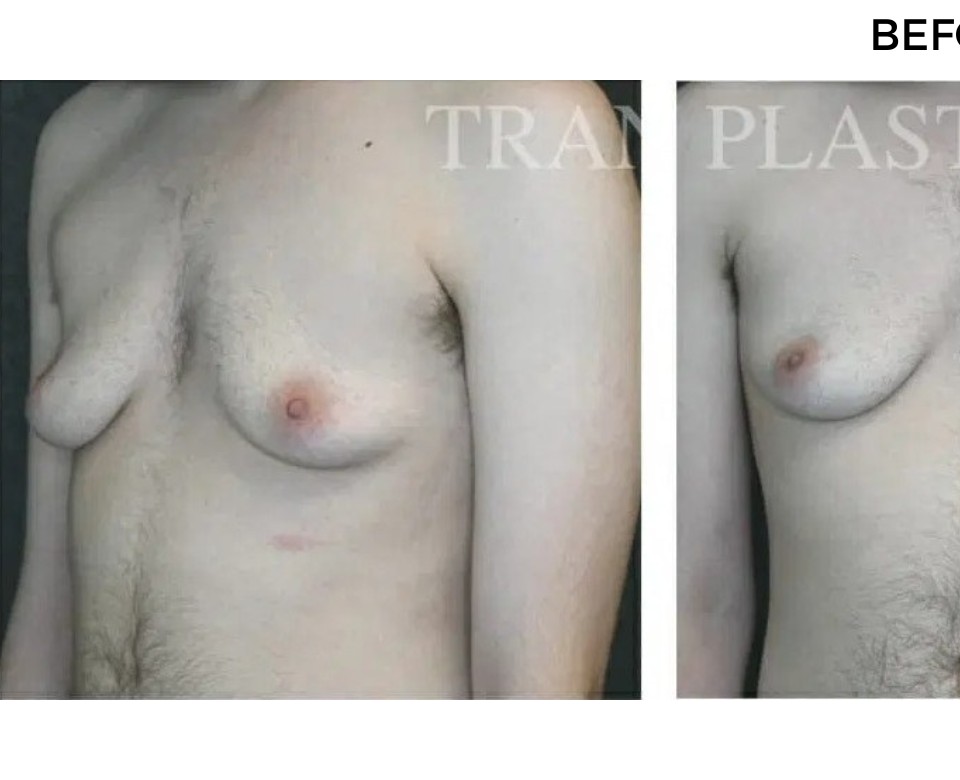Procedure before and after - before