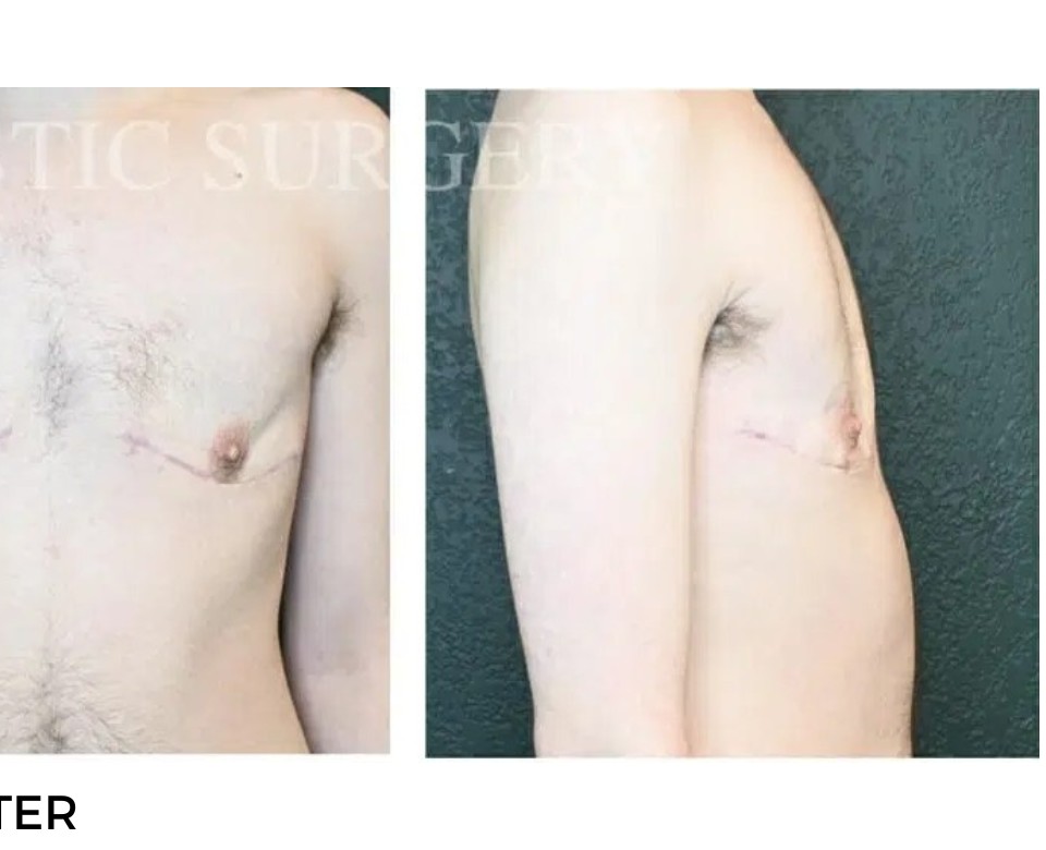 Procedure before and after - after