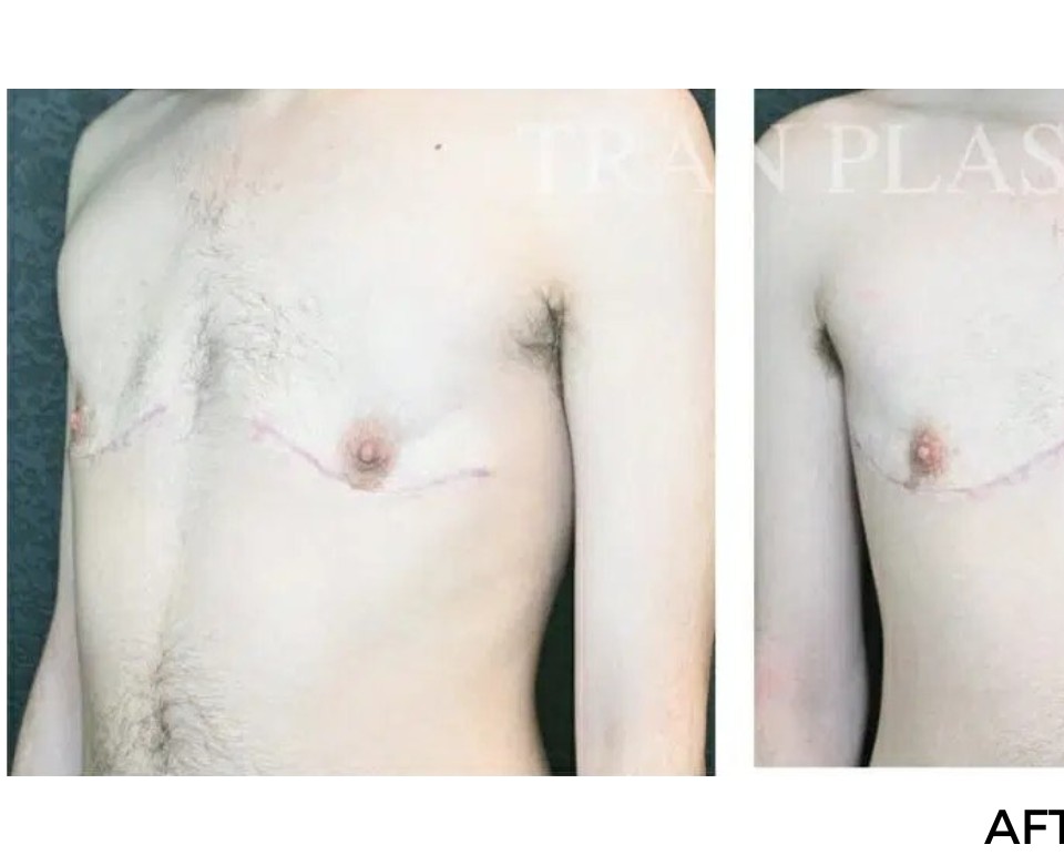 Procedure before and after - before