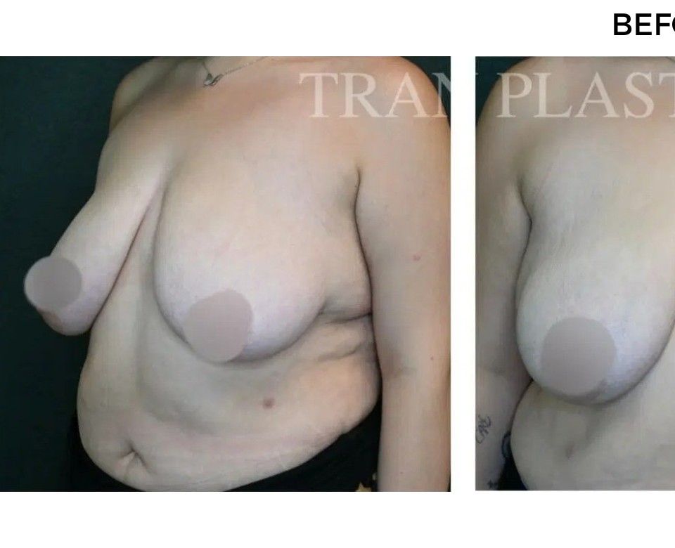 Procedure before and after - before