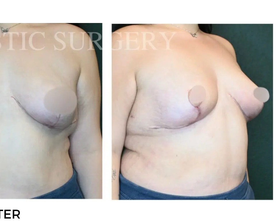 Procedure before and after - after