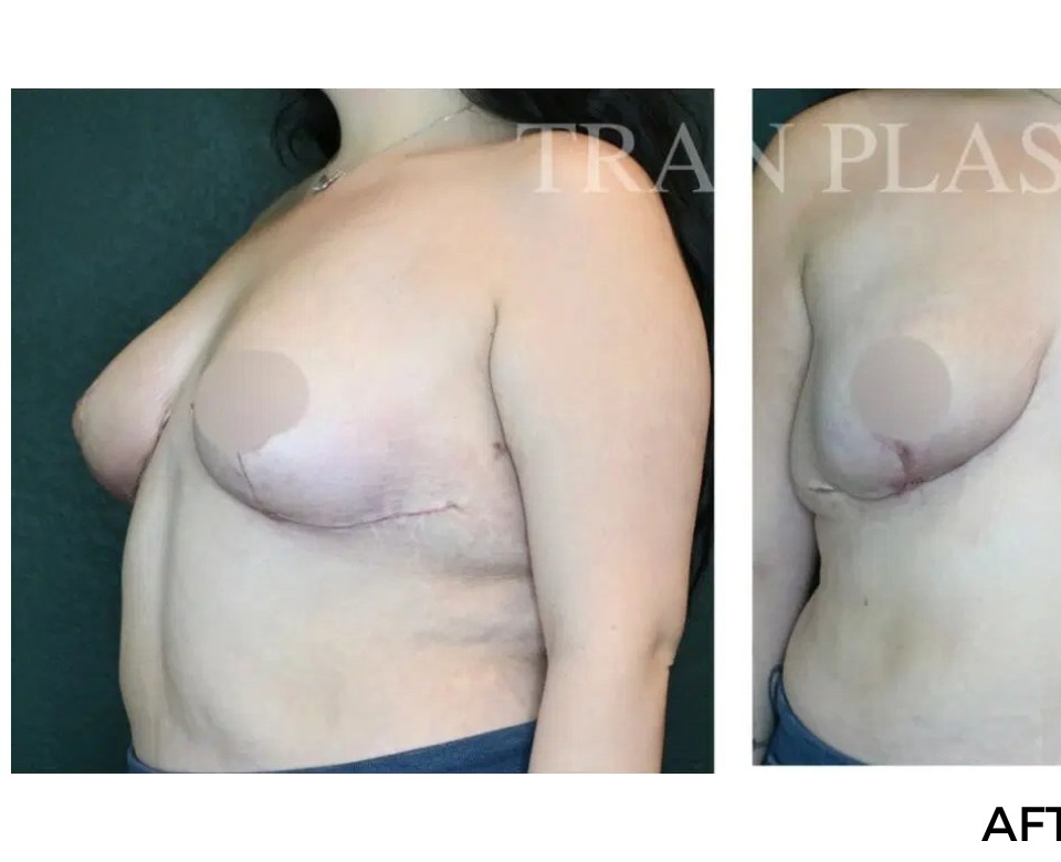 Procedure before and after - before