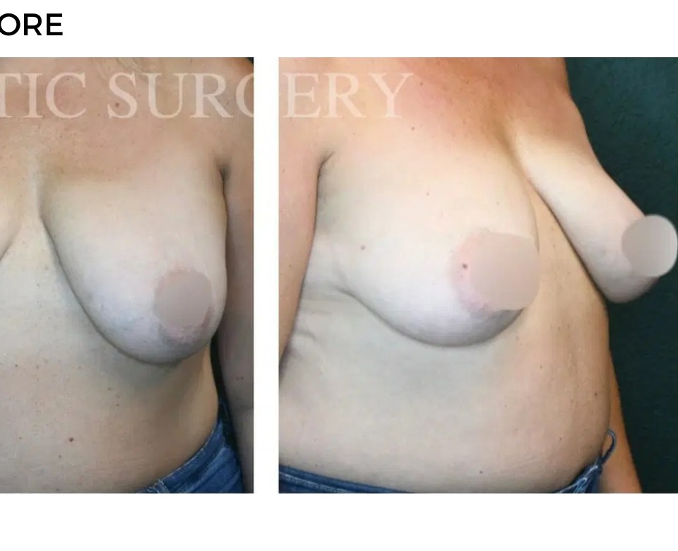 Procedure before and after - after