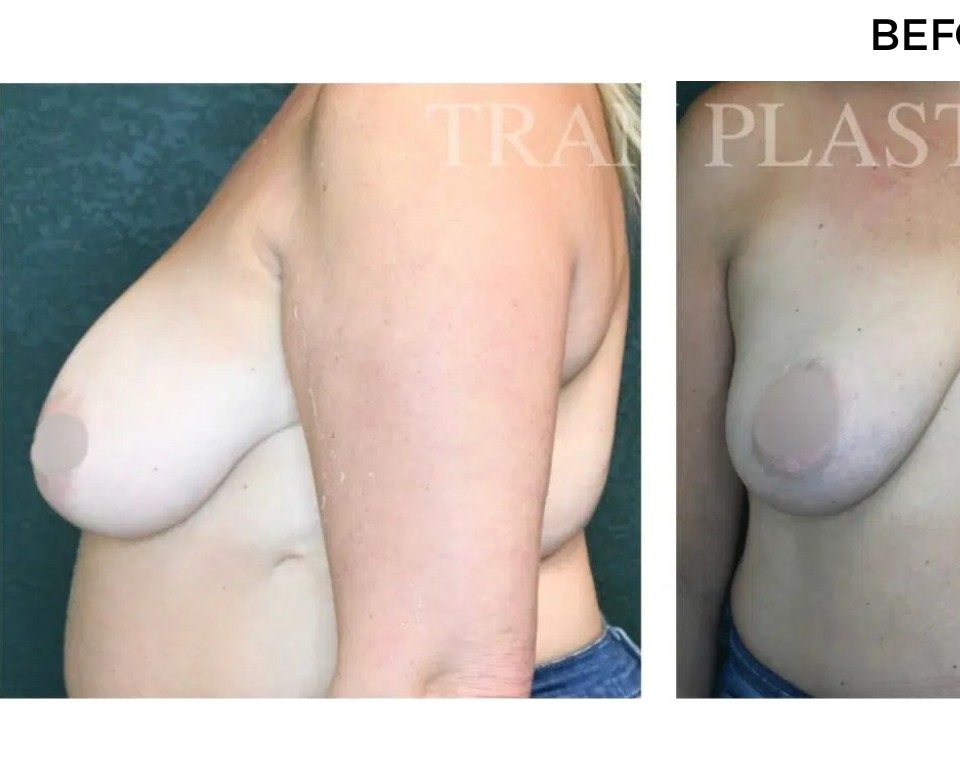 Procedure before and after - before