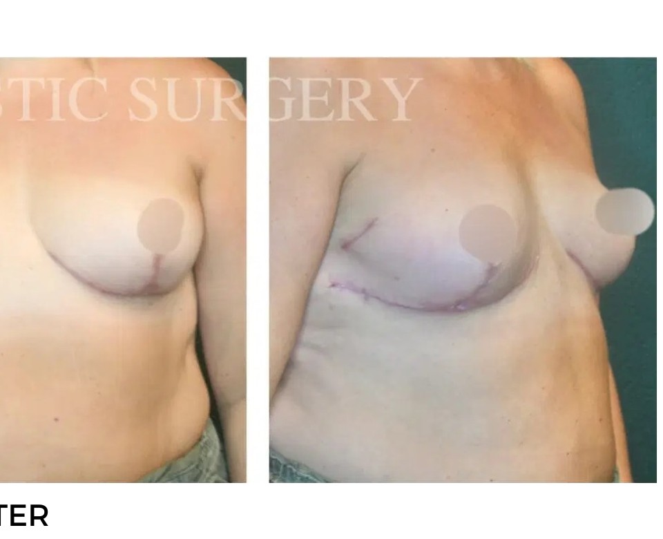 Procedure before and after - after