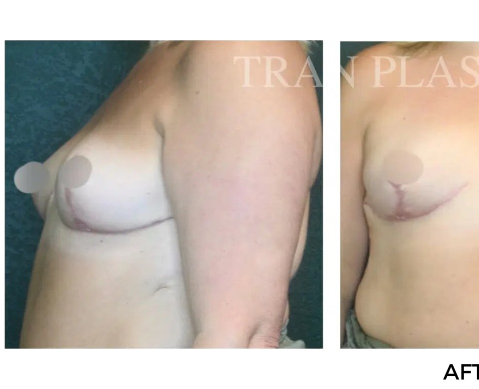Procedure before and after - before