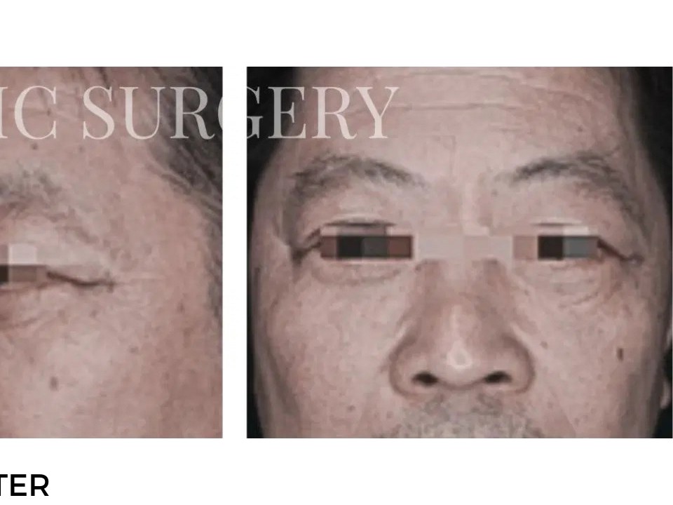 Procedure before and after - after