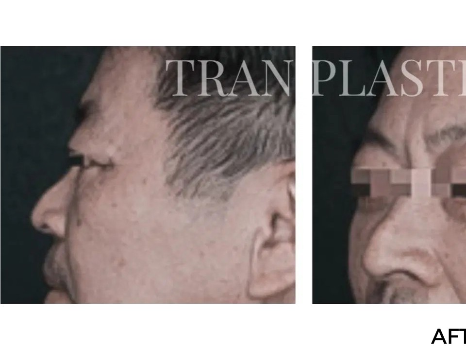 Procedure before and after - before