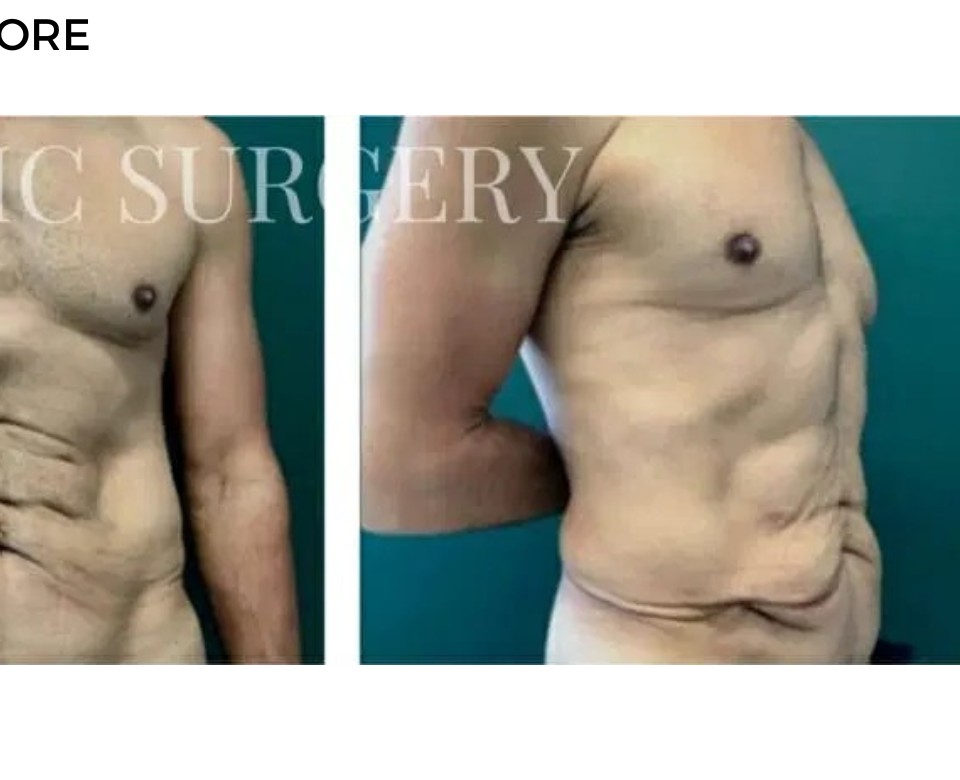 Procedure before and after - after