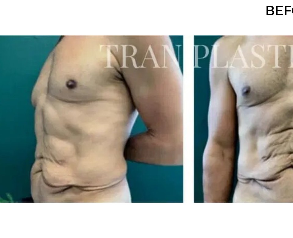 Procedure before and after - before