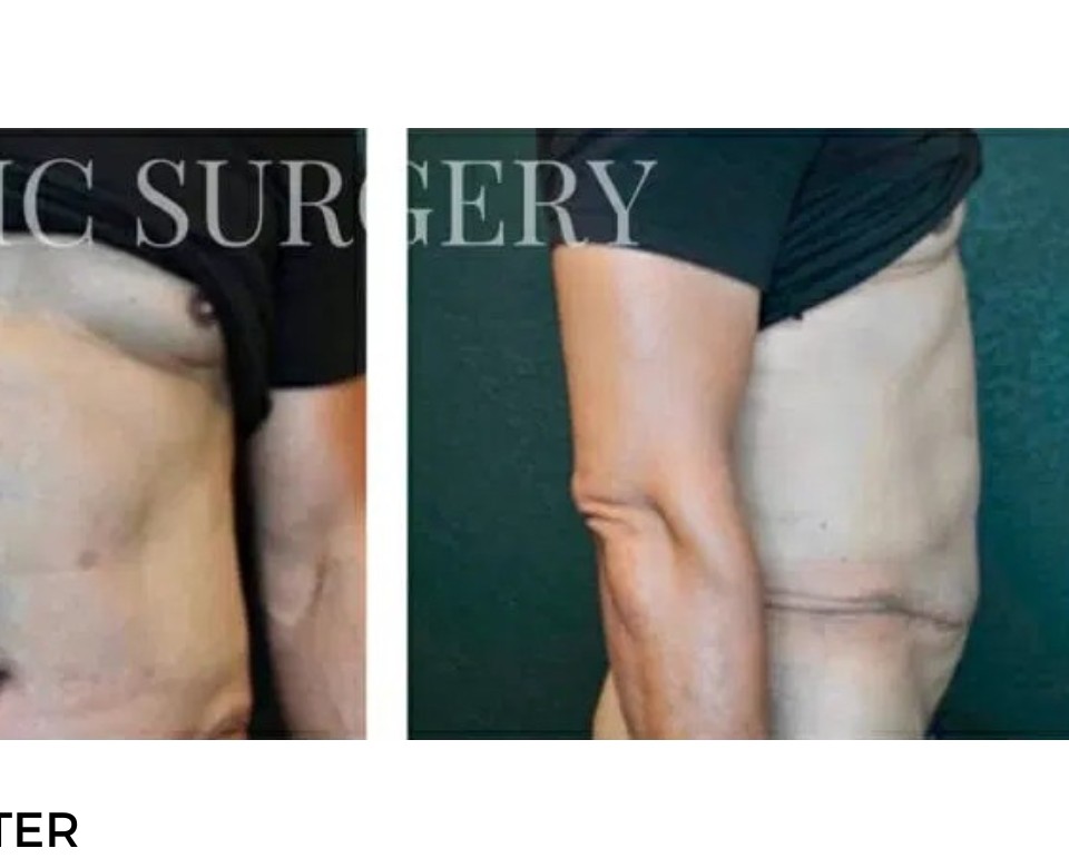 Procedure before and after - after