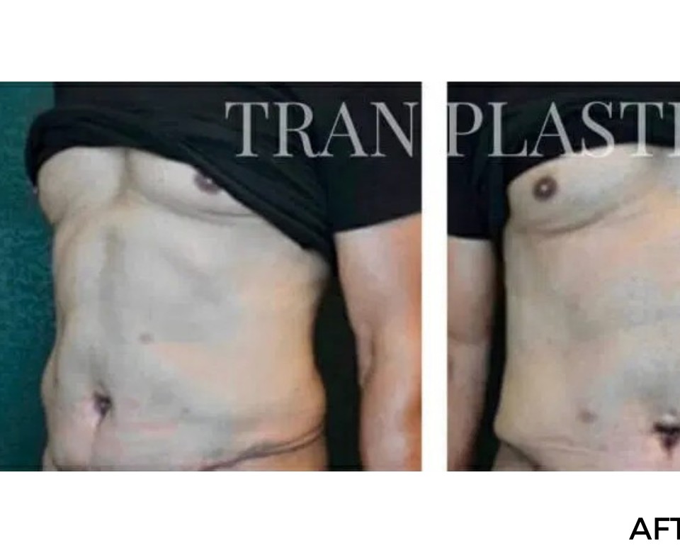Procedure before and after - before