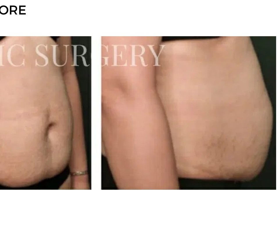 Procedure before and after - after