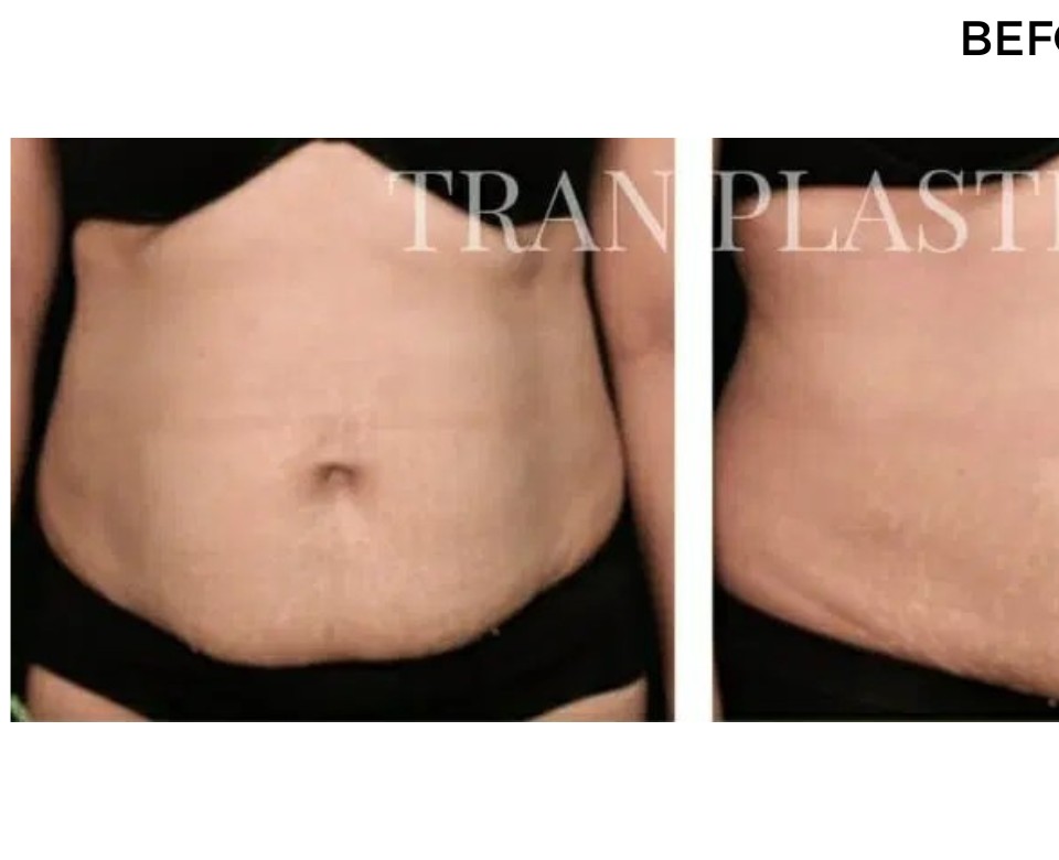 Procedure before and after - before
