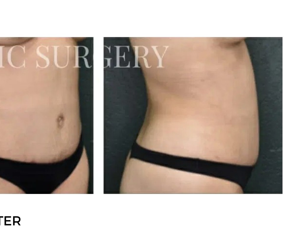 Procedure before and after - after