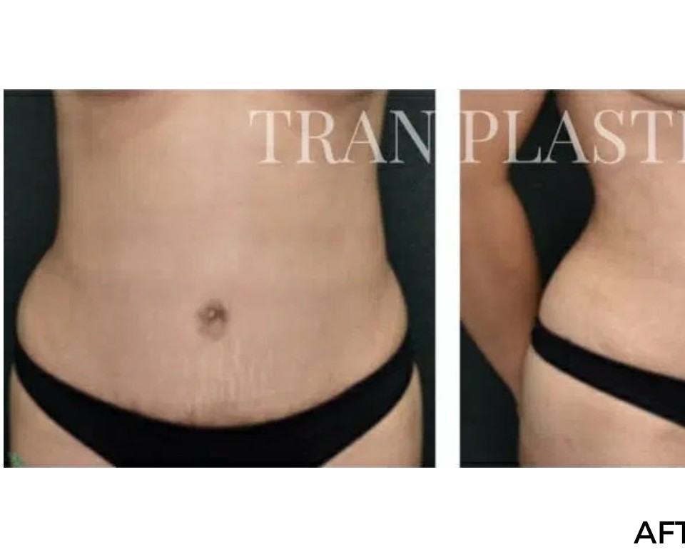 Procedure before and after - before